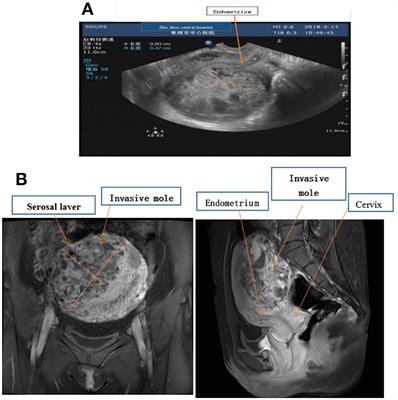 Invasive Mole Resulting in Uterine Rupture: A Case Report